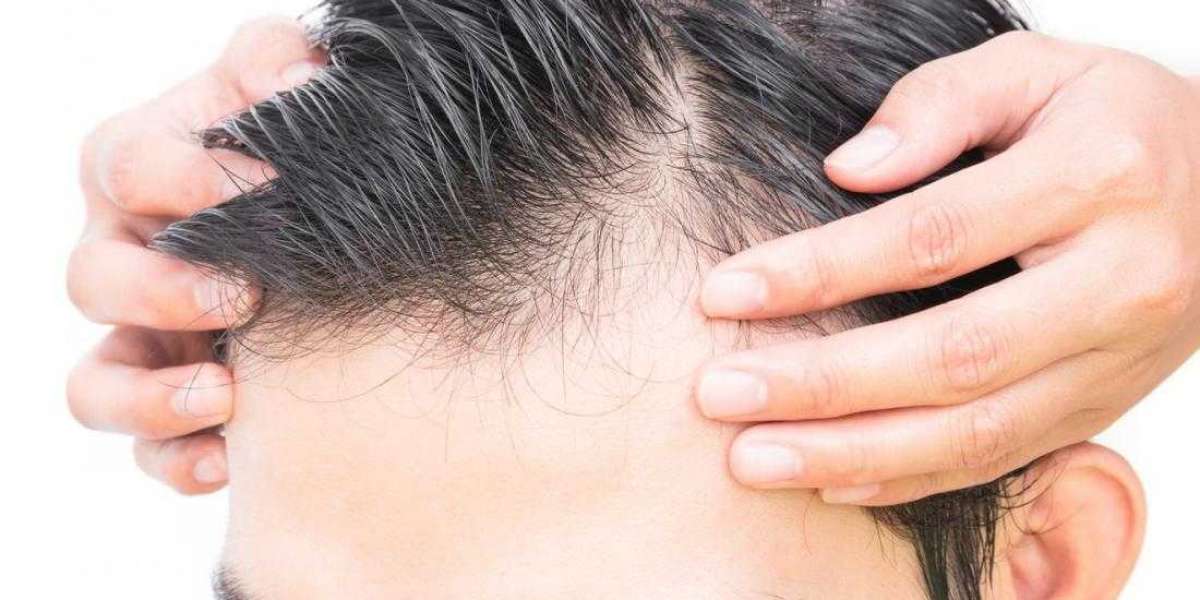 Female Pattern Baldness: Misconceptions and Best Treatment